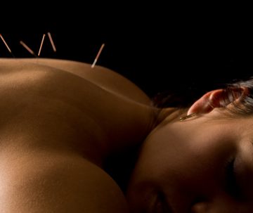 Acupuncture